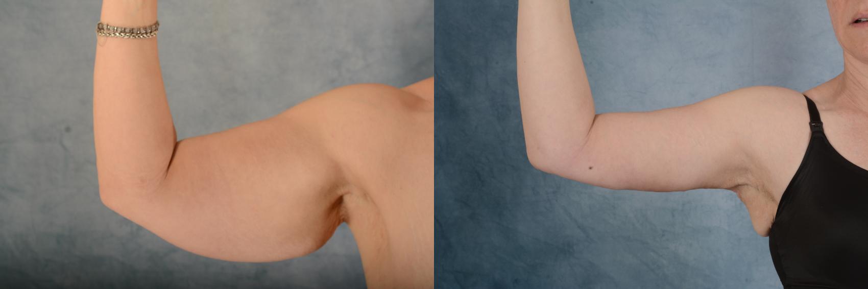 Before & After Arm Lift (Brachioplasty) Case 621 Front View in Tallahassee, FL