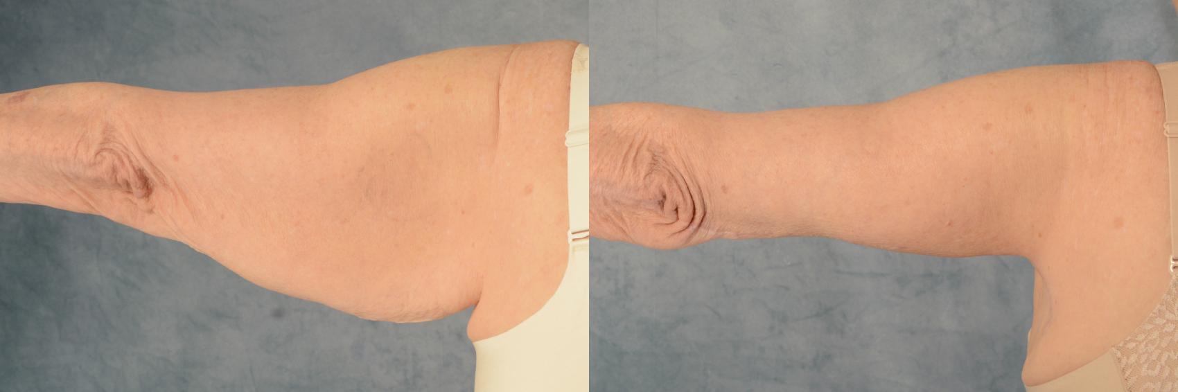 Before & After Arm Lift (Brachioplasty) Case 623 Back View in Tallahassee, FL