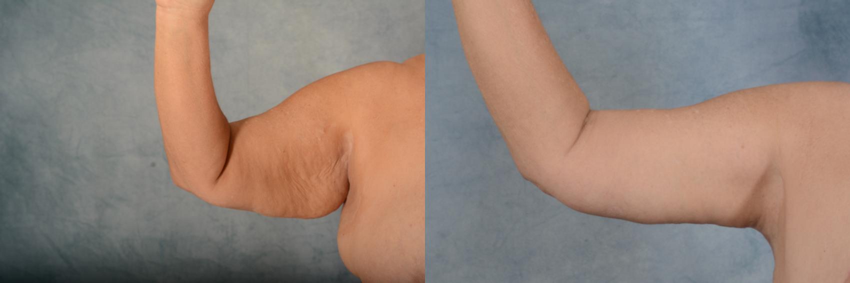Before & After Arm Lift (Brachioplasty) Case 637 Right Side View in Tallahassee, FL