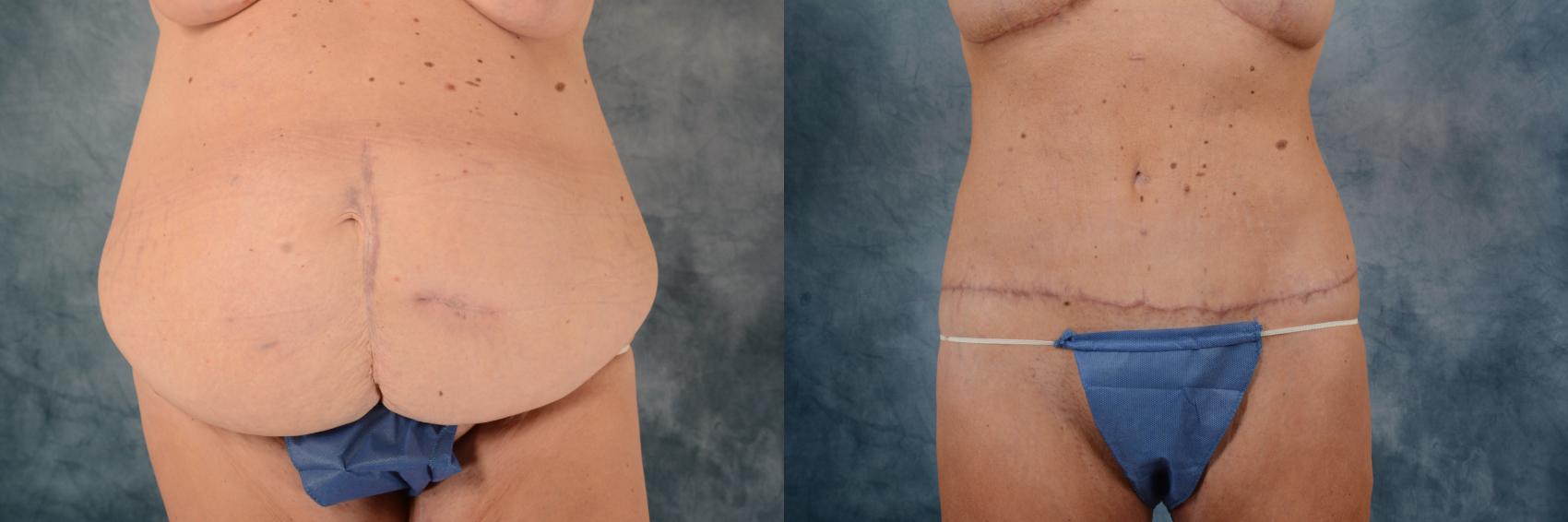 Before & After Body Lift after massive weight loss Case 615 Front View in Tallahassee, FL