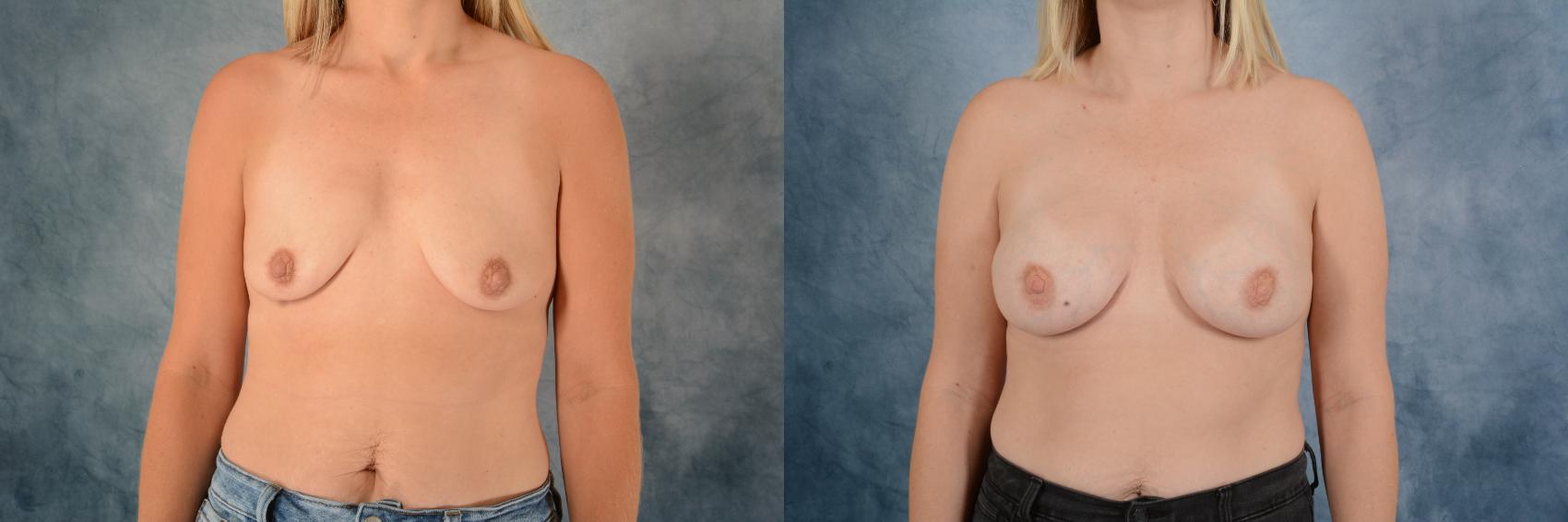 Before & After Breast Augmentation Case 618 Front View in Tallahassee, FL