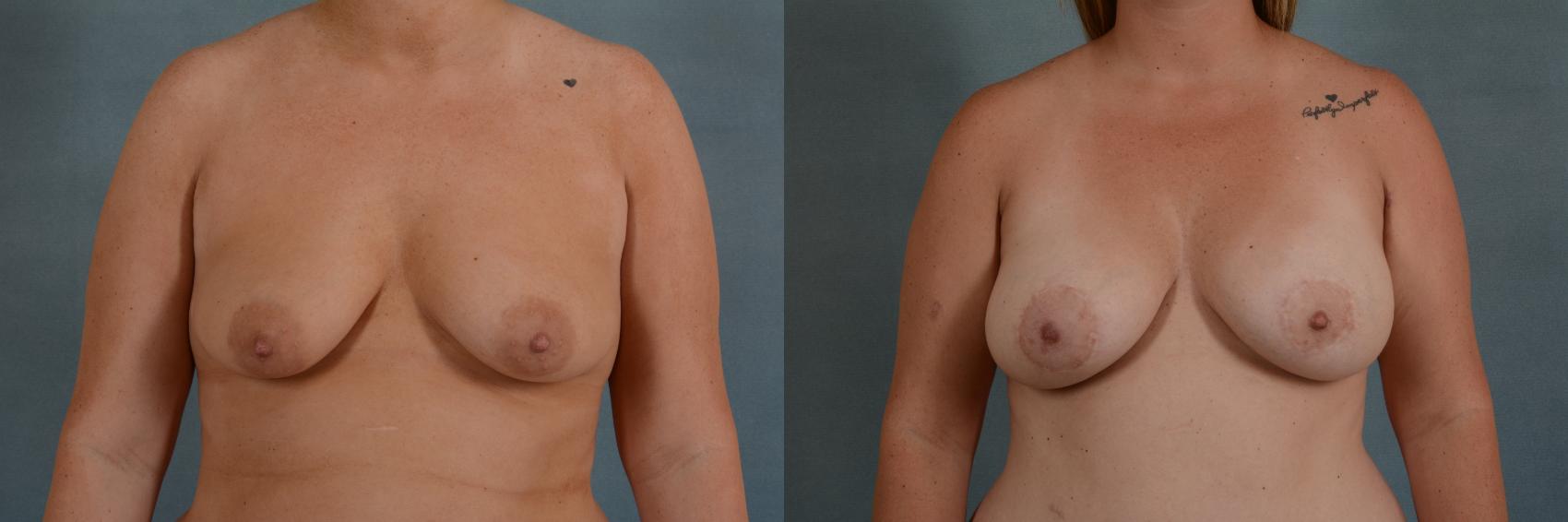 Before & After Breast Lift (Mastopexy) with Implants Case 629 Front View in Tallahassee, FL