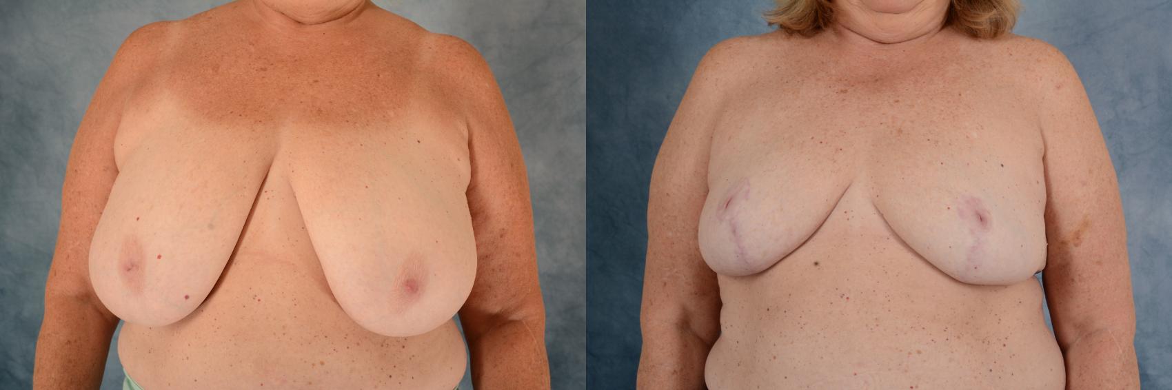 Before & After Breast Reduction Case 607 Front View in Tallahassee, FL