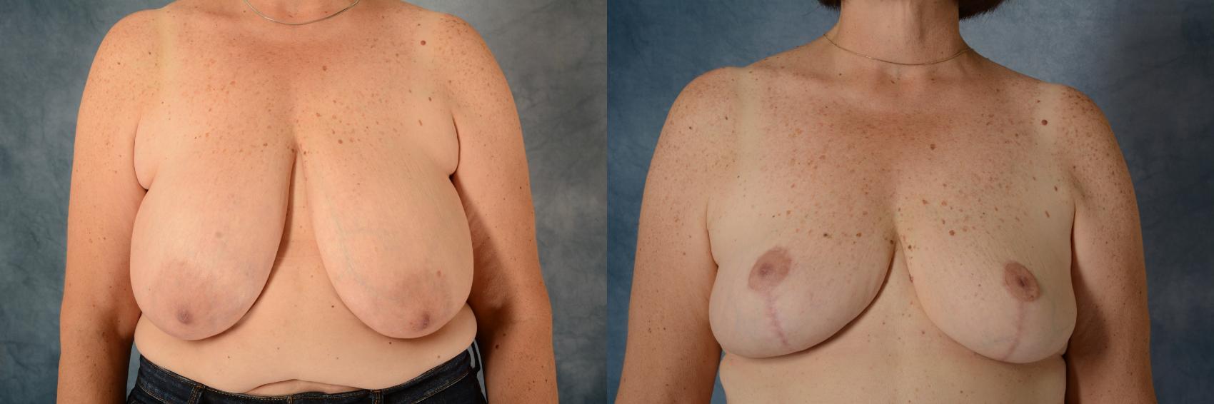 Before & After Breast Reduction Case 617 Front View in Tallahassee, FL