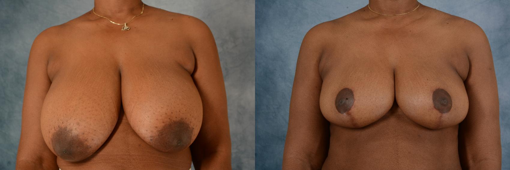 Before & After Breast Reduction Case 619 Front View in Tallahassee, FL