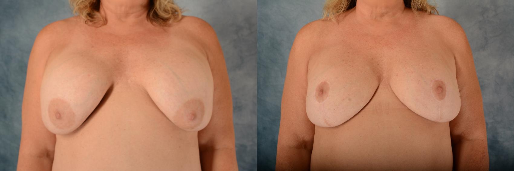 Before & After Breast Revision Surgery Case 616 Front View in Tallahassee, FL