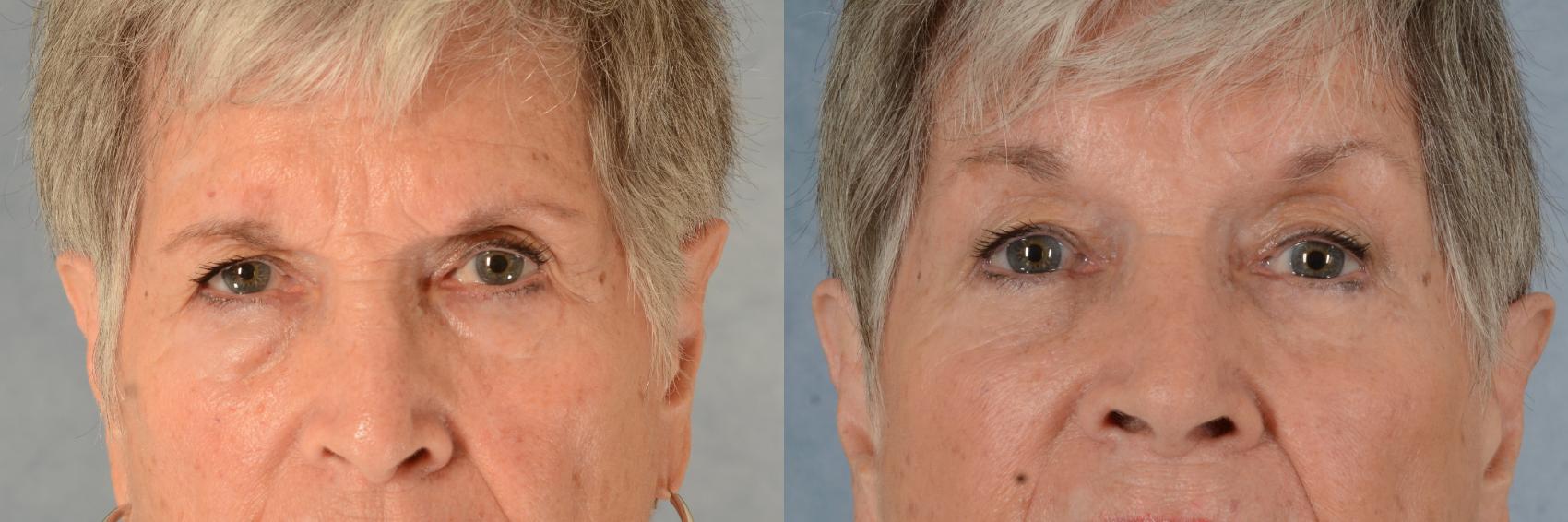Before & After Brow Lift Case 605 Front View in Tallahassee, FL