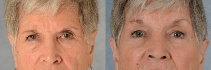 Before & After Brow Lift Case 605 Front View in Tallahassee, FL