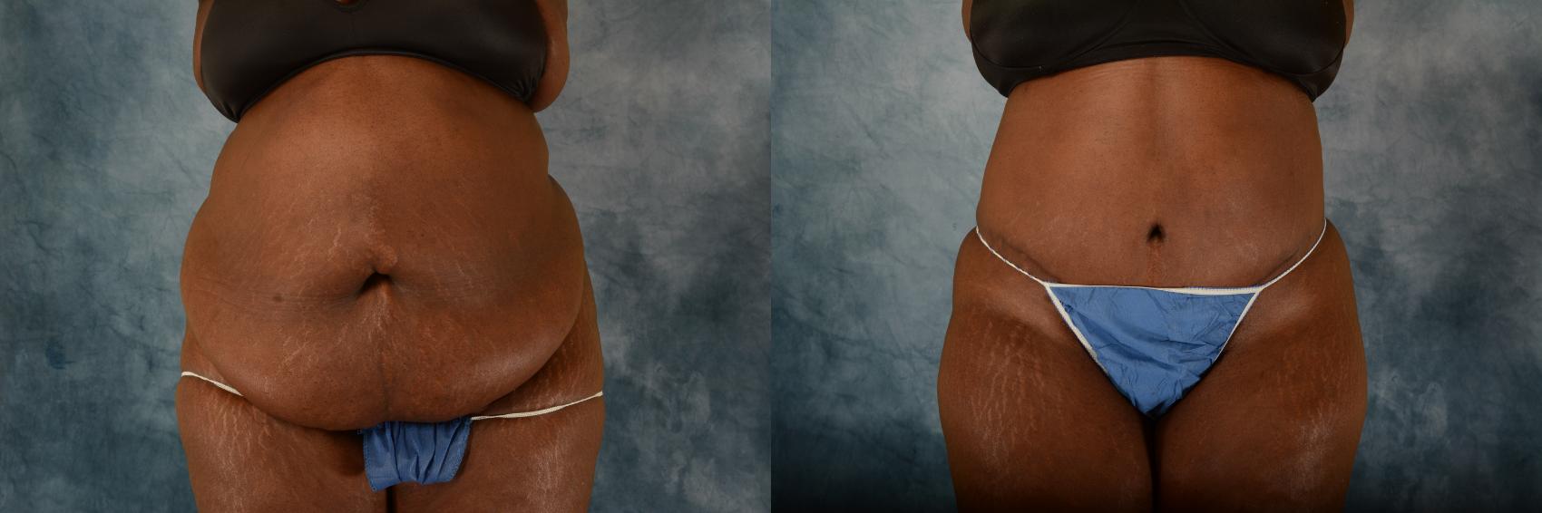 Before & After Extended Tummy Tuck (Abdominoplasty) Case 606 Front View in Tallahassee, FL