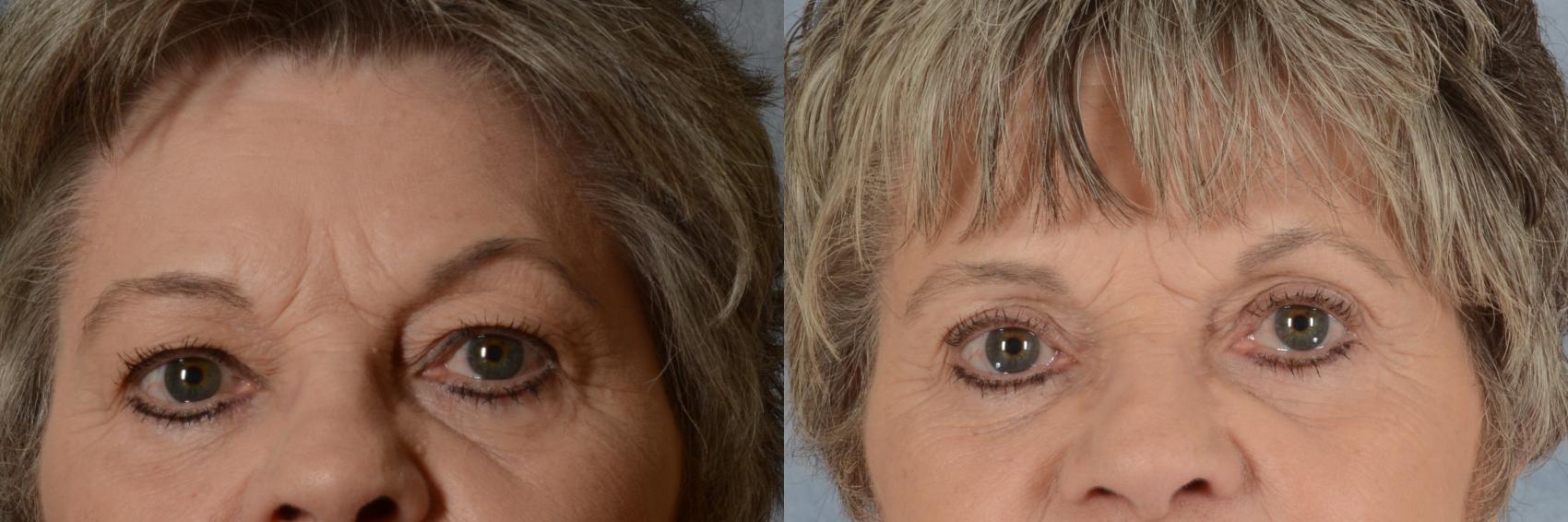 Before & After Eyelid Surgery (Blepharoplasty) Case 603 Front View in Tallahassee, FL