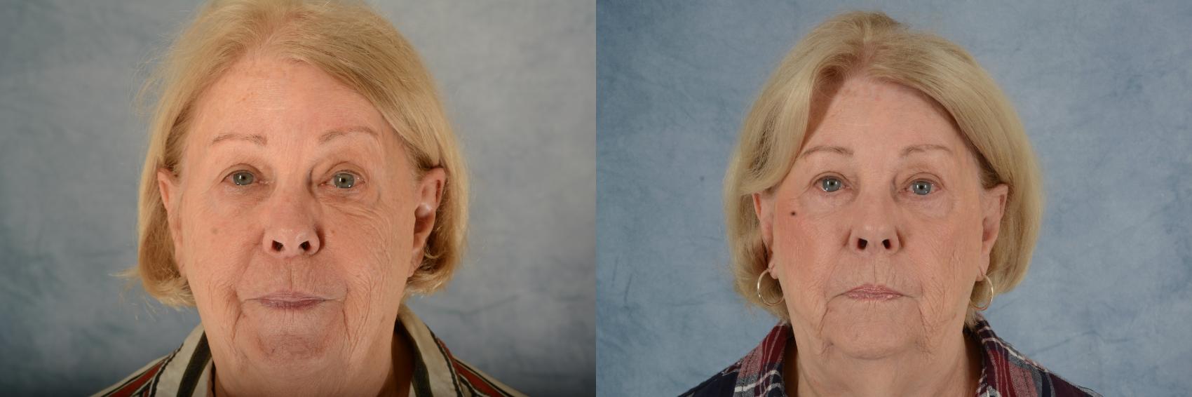 Before & After Eyelid Surgery (Blepharoplasty) Case 604 Front View in Tallahassee, FL