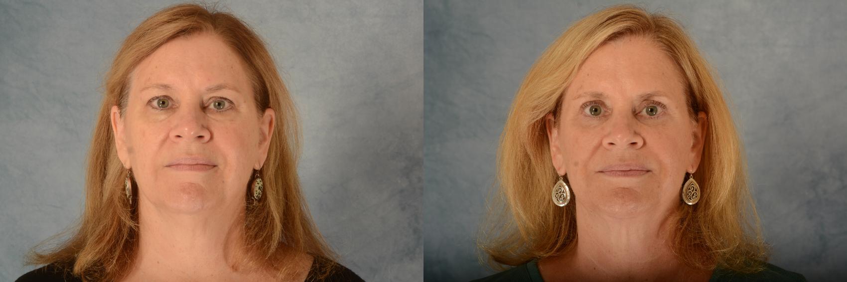 Before & After Eyelid Surgery (Blepharoplasty) Case 609 Front View in Tallahassee, FL