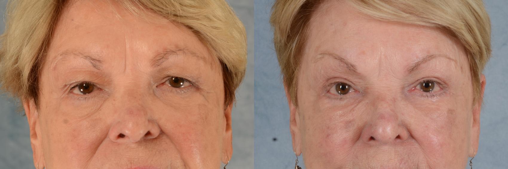 Before & After Eyelid Surgery (Blepharoplasty) Case 610 Front View in Tallahassee, FL