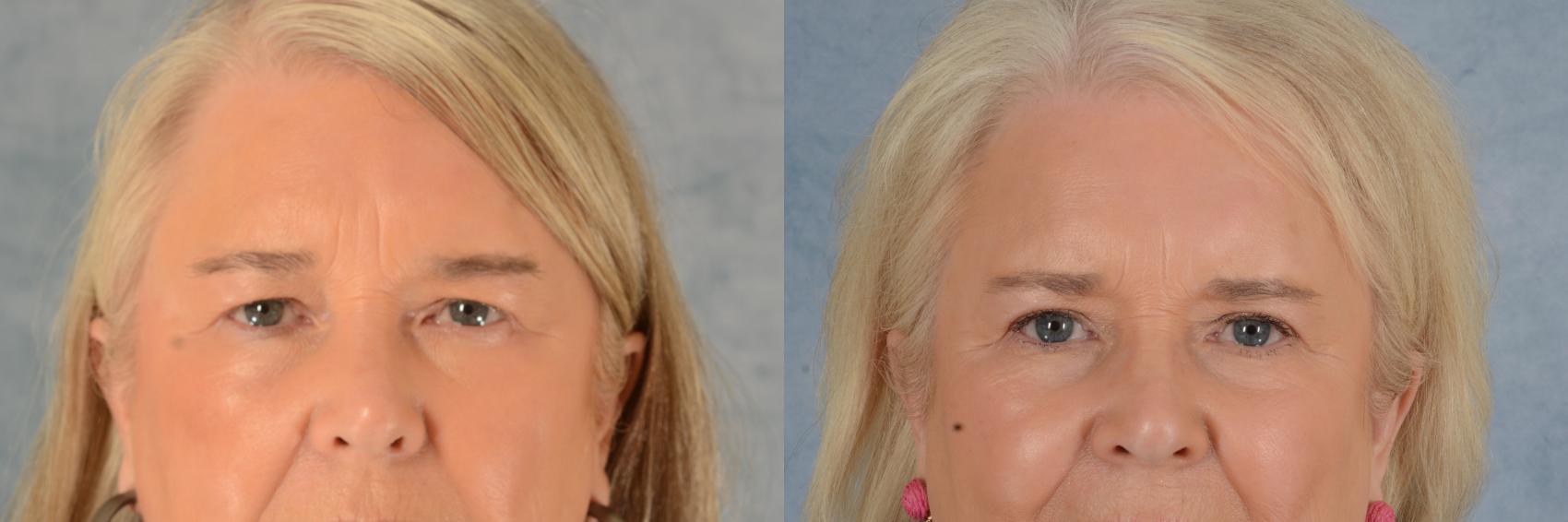 Before & After Eyelid Surgery (Blepharoplasty) Case 613 Front View in Tallahassee, FL