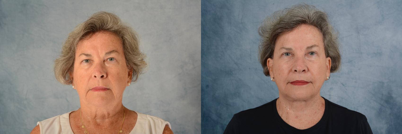 Before & After Facelift Case 630 Front View in Tallahassee, FL