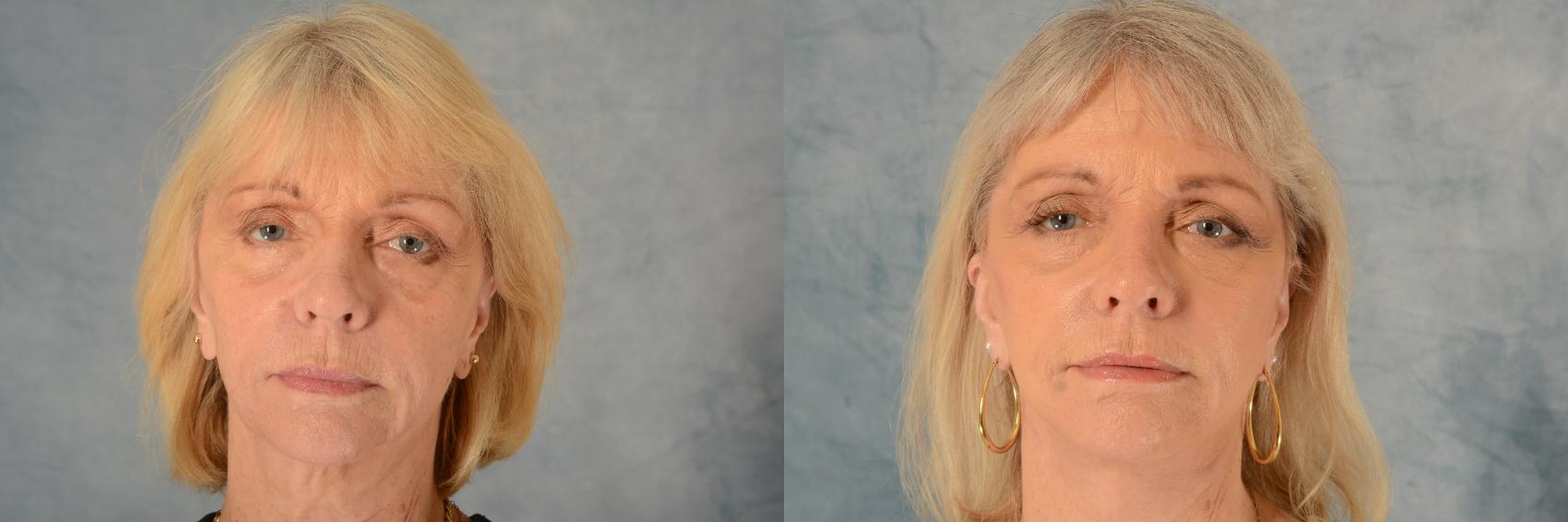 Before & After Facelift Case 631 Front View in Tallahassee, FL
