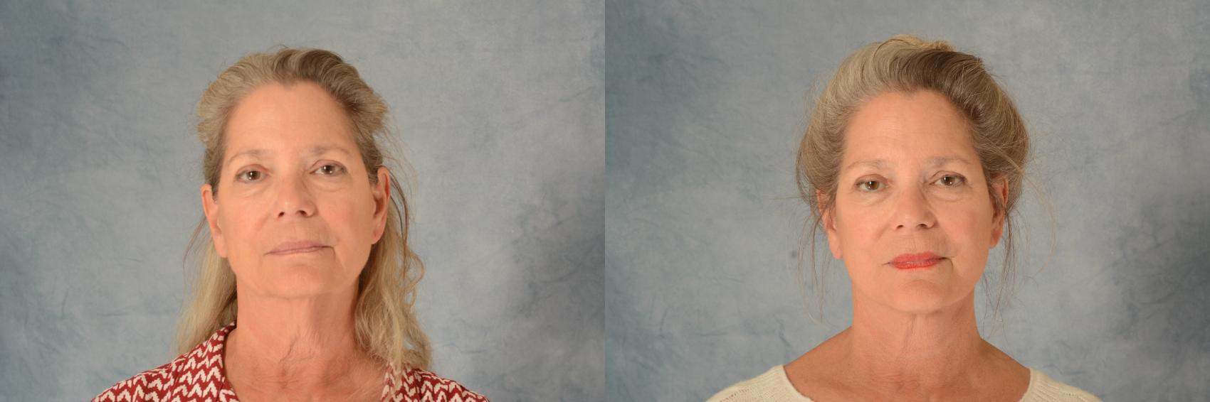 Before & After Facelift Case 633 Front View in Tallahassee, FL