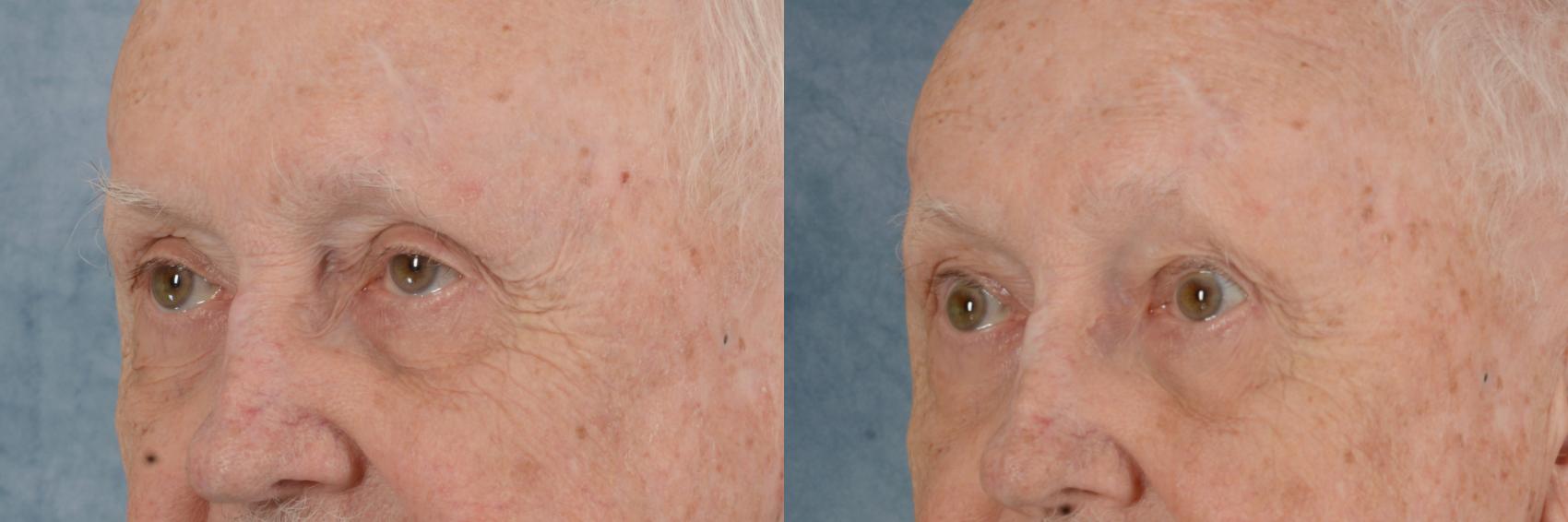 Before & After Oculoplastic Surgery Case 627 Left Oblique View in Tallahassee, FL