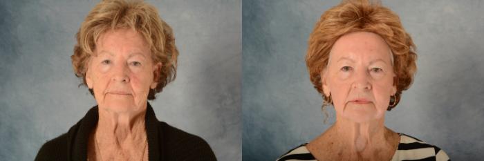 Before & After Physician Performed Chemical Peels Case 639 Front View in Tallahassee, FL