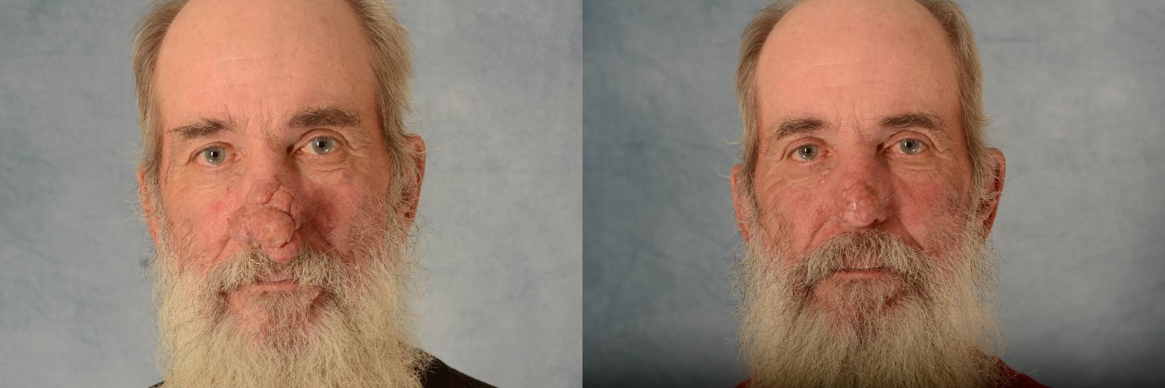 Before & After Rhinoplasty Case 624 Front View in Tallahassee, FL
