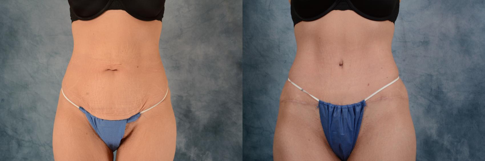 Before & After Tummy Tuck (Abdominoplasty) Case 614 Front View in Tallahassee, FL
