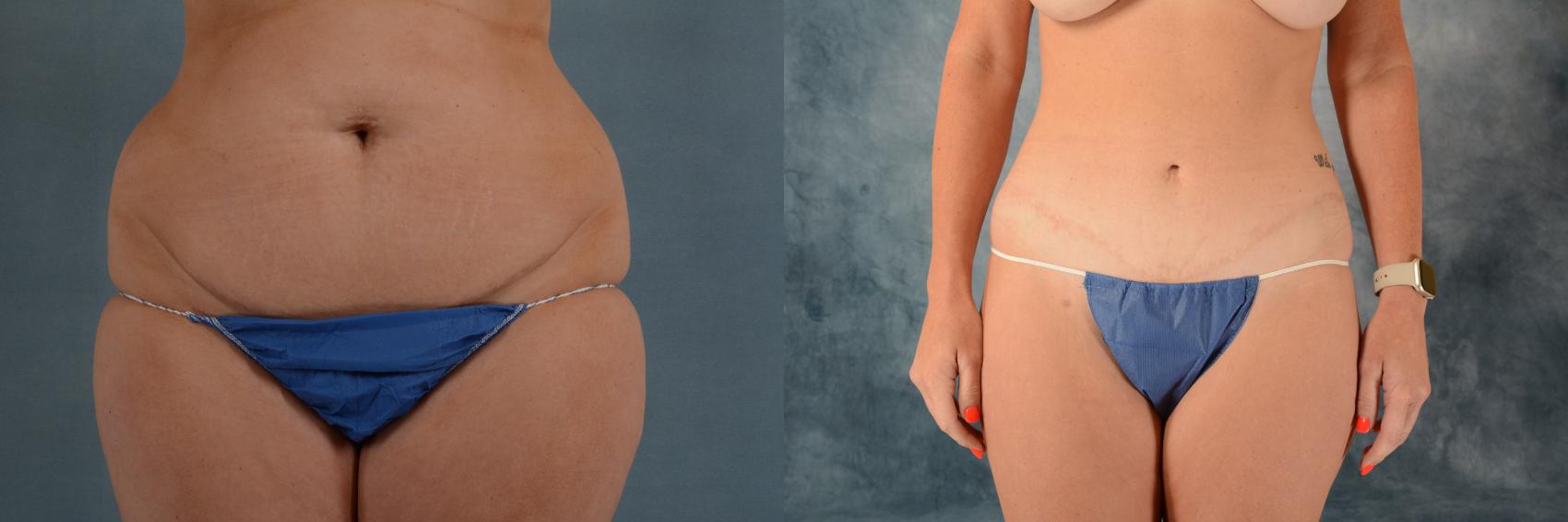 Before & After Tummy Tuck (Abdominoplasty) Case 628 Front View in Tallahassee, FL
