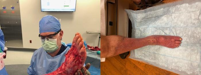 Before & After Advanced Wound Care Case 348 View #1 View in Tallahassee, FL
