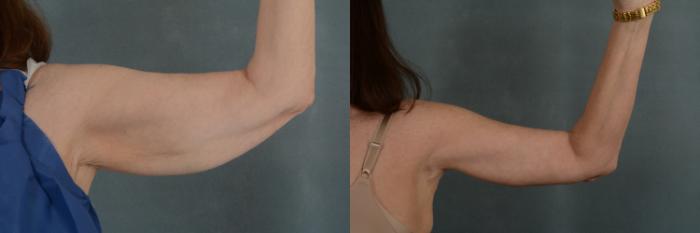 Before & After Arm Lift (Brachioplasty) Case 300 View #1 View in Tallahassee, FL
