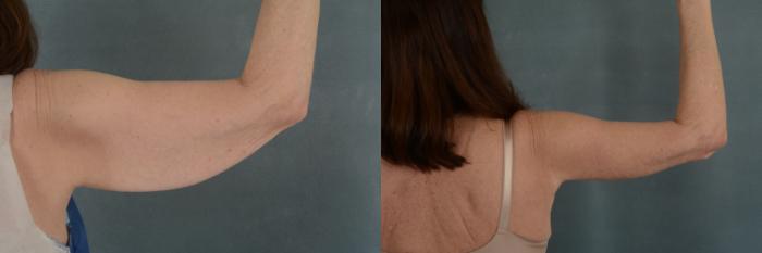 Before & After Arm Lift (Brachioplasty) Case 300 View #2 View in Tallahassee, FL