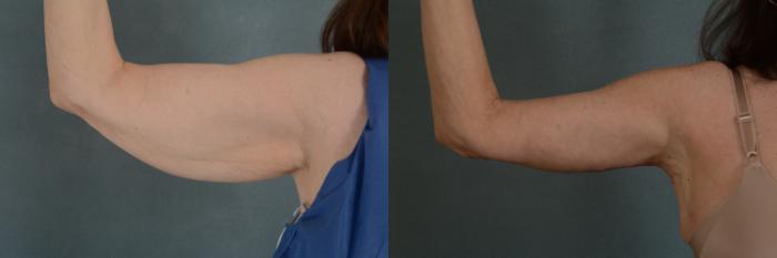 Before & After Arm Lift (Brachioplasty) Case 300 View #3 View in Tallahassee, FL