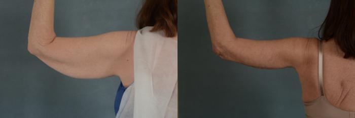 Before & After Arm Lift (Brachioplasty) Case 300 View #4 View in Tallahassee, FL