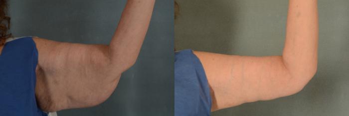 Before & After Arm Lift (Brachioplasty) Case 374 View #1 View in Tallahassee, FL