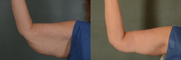 Before & After Arm Lift (Brachioplasty) Case 374 View #2 View in Tallahassee, FL
