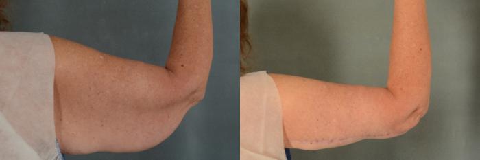 Before & After Arm Lift (Brachioplasty) Case 374 View #3 View in Tallahassee, FL