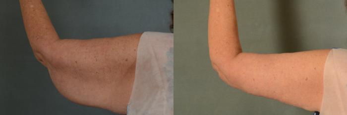 Before & After Arm Lift (Brachioplasty) Case 374 View #4 View in Tallahassee, FL