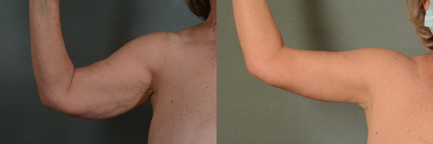 Before & After Arm Lift (Brachioplasty) Case 377 View #1 View in Tallahassee, FL
