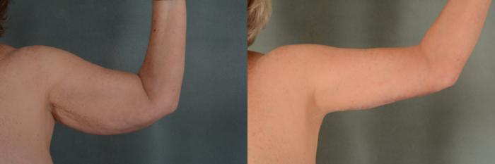 Before & After Arm Lift (Brachioplasty) Case 377 View #2 View in Tallahassee, FL