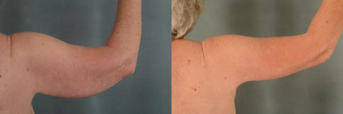 Before & After Arm Lift (Brachioplasty) Case 377 View #3 View in Tallahassee, FL