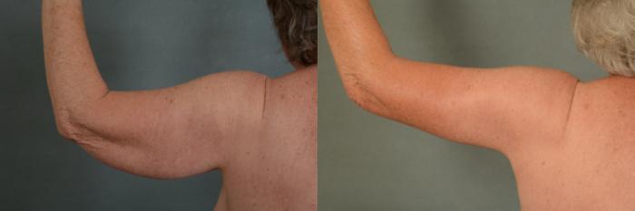 Before & After Arm Lift (Brachioplasty) Case 377 View #4 View in Tallahassee, FL