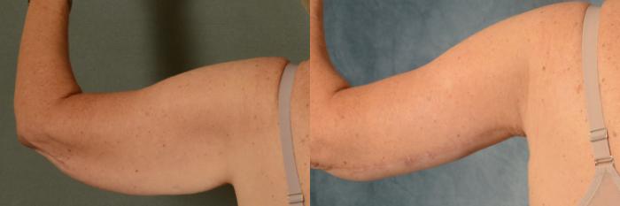Before & After Arm Lift (Brachioplasty) Case 450 Back View in Tallahassee, FL