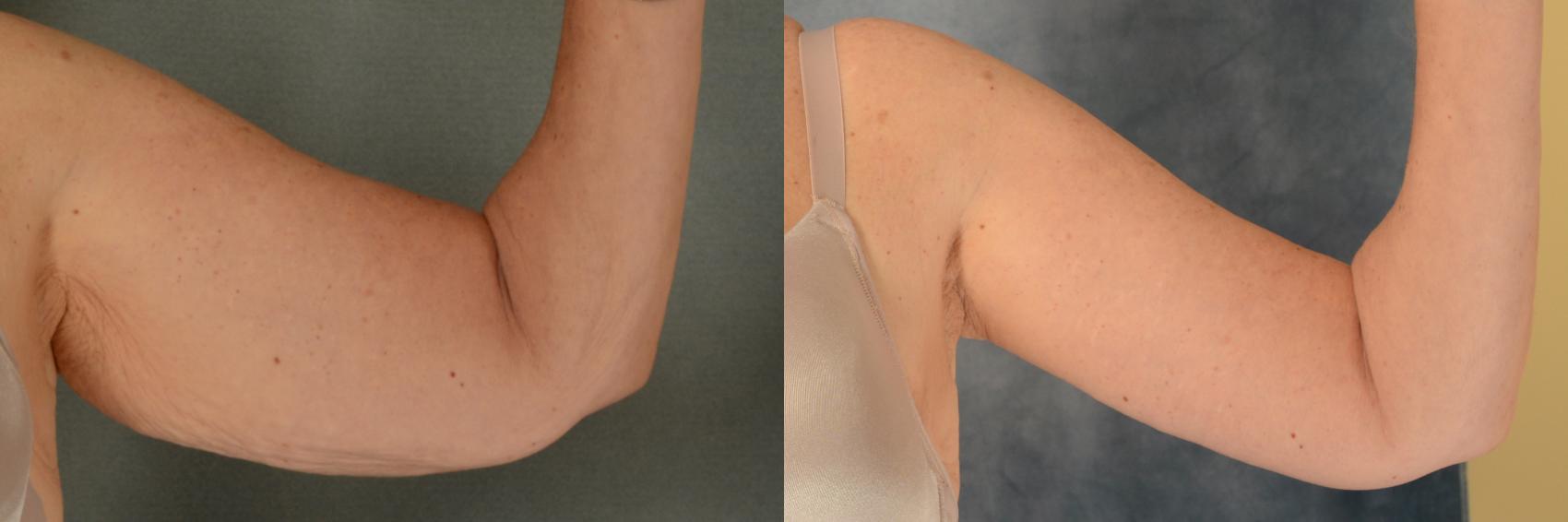 Before & After Arm Lift (Brachioplasty) Case 450 Front View in Tallahassee, FL