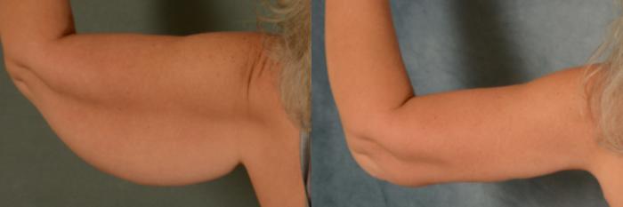 Before & After Arm Lift (Brachioplasty) Case 453 Back View in Tallahassee, FL