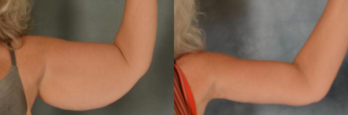 Before & After Arm Lift (Brachioplasty) Case 453 Front View in Tallahassee, FL