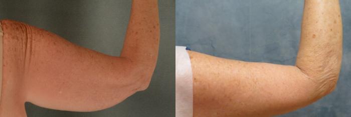 Before & After Arm Lift (Brachioplasty) Case 460 Back View in Tallahassee, FL