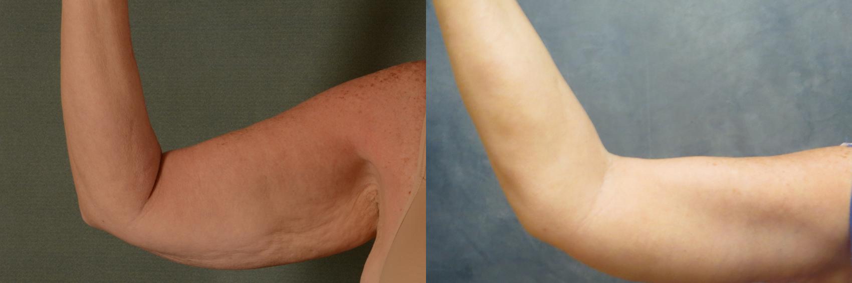 Before & After Arm Lift (Brachioplasty) Case 460 Front View in Tallahassee, FL
