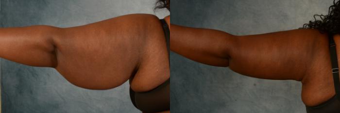 Before & After Arm Lift (Brachioplasty) Case 494 Back View in Tallahassee, FL