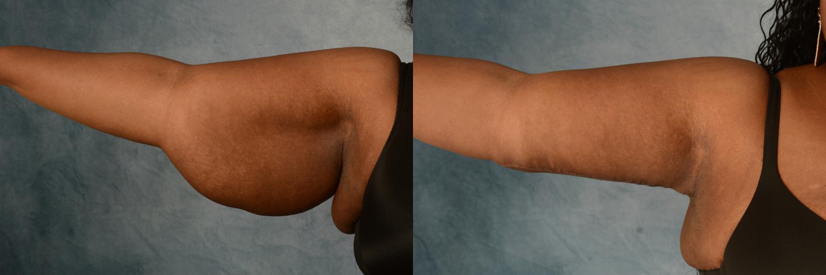 Before & After Arm Lift (Brachioplasty) Case 494 Front View in Tallahassee, FL