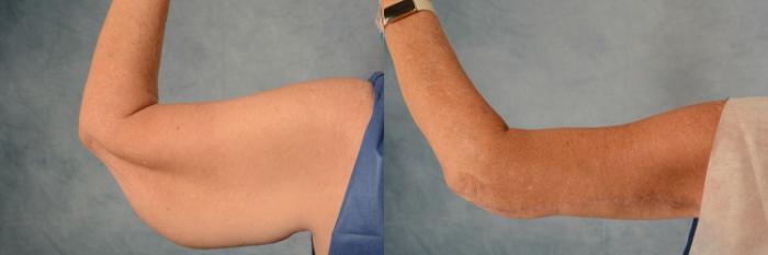 Before & After Arm Lift (Brachioplasty) Case 505 Back View in Tallahassee, FL