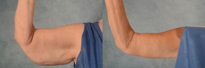 Before & After Arm Lift (Brachioplasty) Case 505 Front View in Tallahassee, FL