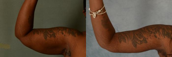 Before & After Arm Lift (Brachioplasty) Case 569 Front View in Tallahassee, FL